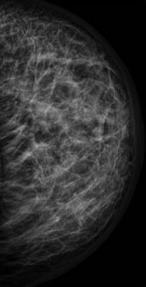 Mamografía de mama izquierda.