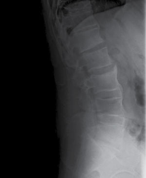 Espondiloartritis Axial Espondilitis Anquilosante Medicine