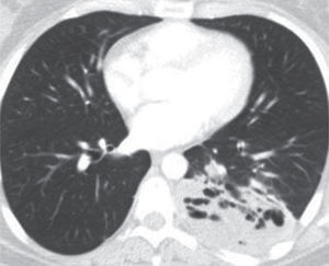 Secuestro intralobar localizado en el lóbulo inferior izquierdo. Secuestro intralobar localizado en el lóbulo inferior izquierdo.