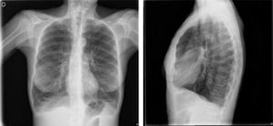 Radiografía de tórax posteroanterior y lateralde la paciente.