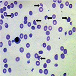 Peripheral blood smear stained with the Giemsa procedure. The black arrows indicate the schizocytes.