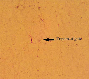 Tinción con May-Grünwald/Giemsa diluido. La presencia de un tripomastigote (1000×) en líquido cefalorraquídeo obtenido de un paciente HIV/sida con encefalitis se indica con una flecha.