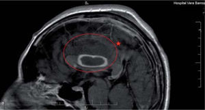 Imagen de resonancia magnética nuclear (RMN) de un paciente HIV/sida con encefalitis. Se muestra dentro del círculo una colección abscesada en el cuerpo calloso, que se tiñe periféricamente con inyección de contraste endovenoso, acompañada de un edema perilesional reactivo.