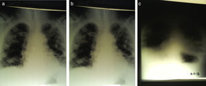 Serial chest radiographs from February 3rd at (a) 12.00 pm; (b) 5.00 pm; (c) 9.00 pm.