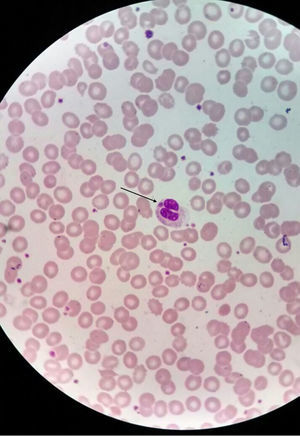 Frotis de sangre periférica teñido con Wright-Giemsa (objetivo 100×). La flecha señala un neutrófilo con inclusión intracitoplasmática compatible con mórula de Anaplasmasp.