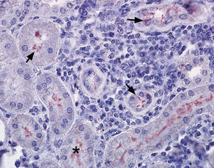 Kidney, immunostaining can be found as thin fibers between tubular cells and over the epithelial cells (arrows →), and with a diffuse pattern within the tubules (*). The interstitial tissue appeared infiltrated with lymphocytic cells (1). Immunohistochemistry, AEC (solution aminoethylcarbazole) – haematoxylin-eosin. 400×.