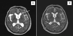 A) RM craneal axial T2 en la que se aprecian los quistes en la cisura de Silvio e hidrocefalia con sufusión transependimaria (flecha). B) RM craneal axial T2 con válvula de derivación ventricular en asta occipital derecha (flecha), disminución del tamaño de los quistes en la cisura de Silvio y mejoría de la hidrocefalia.