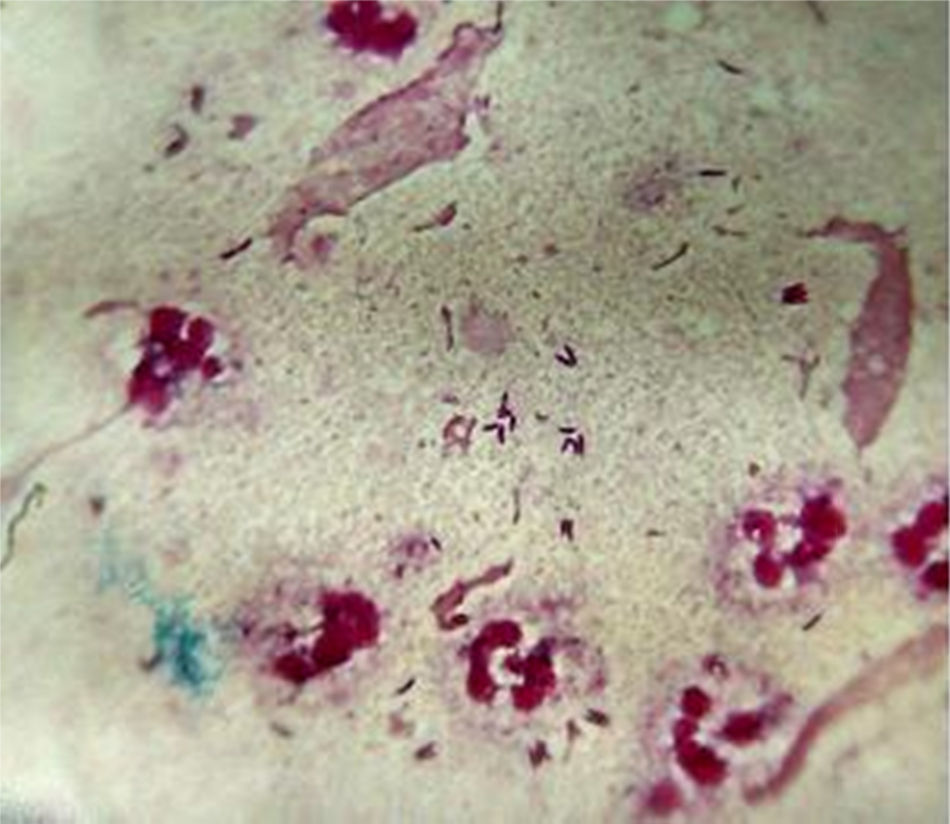 Neumon a Por Corynebacterium Pseudodiphtheriticum Revista Argentina neumon-a-por-corynebacterium-pseudodiphtheriticum-revista-argentina