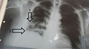 Chest radiograph. Alveolar pattern in the lower third of right lung (arrow 1) and blunting of the right costophrenic angle (arrow 2).