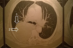 Computer axial tomography. Rounded mass with thickened wall (arrow 1) and heterogeneous liquid content (arrow 2) inside topography of lower right lobe compatible with lung abscess.