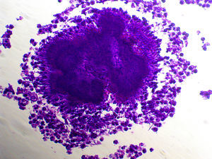 Se observa grano de azufre en una biopsia pleural. Tinción de hematoxilina-eosina 400×.