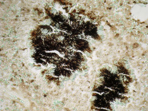 Se observa grano de azufre con bacterias formando una empalizada en una biopsia pleural. Tinción Gomori-Grocott 400×.