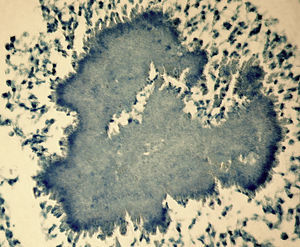 Se observa grano de azufre sin bacterias ácido-alcohol resistentes en una biopsia pleural. Tinción Ziehl-Neelsen 400 ×.