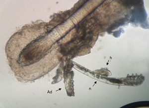 Demodex y morfotipos de su ciclo biológico observados en pestaña de paciente con DEBS. Pestaña parasitada con adulto (Ad), huevo (h) y ninfa (n) de D. folliculorum, 400×.