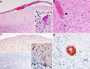 Hallazgos histopatológicos en cerebros de bovinos con rabia paresiante. A. Meningitis linfoplasmocítica en el cerebelo. H&E, 50x. Recuadro: cuerpo de inclusión intracitoplasmático eosinofílico (corpúsculo de Negri) en una neurona de Purkinje. H&E, 400x. B. Inflamación linfoplasmocítica perivascular (flecha) y del neuroparénquima circundante (asterisco) en el tálamo. H&E, 100x. C. Inmunomarcación antigénica del virus de la rabia (precipitados granulares marrón ocre) en la capa molecular del cerebelo. IHQ, 50x. Recuadro: mayor detalle de la inmunomarcación en las dendritas en la capa molecular y citoplasma de las células de Purkinje. IHQ, 400x. D. Inmunomarcación antigénica del virus de la rabia en el citoplasma de una neurona del mesencéfalo; nótese la ausencia de marcación en el área central, correspondiente al núcleo de la misma neurona. IHQ, 400x.