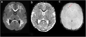 Case 1 – axial magnetic resonance imaging. Diffusion sequence (a) and apparent diffusion coefficient (ADC) map (b) where extensive restrictive areas of diffuse and symmetric distribution are observed, compromising the supratentorial bihemispheric white matter, dorso-lateral nuclei of both thalamus and corpus callosum. T2 * Sequence (c) showing the bleeding area (red arrow).