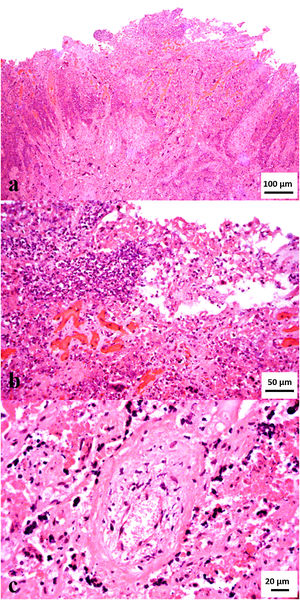 (A) Histologic section of the cotyledonary region of the placenta showing severe extensive inflammatory infiltrate. (B) Higher magnification of Figure 1A. Note abundant degenerate neutrophils admixed with fibrin exudate and karyorrhectic (necrotic) cellular debris (severe extensive fibrinonecrotizing and neutrophilic cotyledonary placentitis. (C) Cross section of a chorionic arteriole (center) depicting concentric necrosis of the tunica media and mural neutrophilic infiltrate (arteriolitis), with abundant fibrin and necrotic debris in the surrounding stroma (hematoxylin and eosin stain, A: 200×, B: 400×, C: 630×).