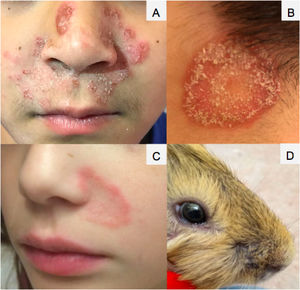 A) Tinea faciei en la región centrofacial con compromiso periorificial. Placa inflamatoria, eritematosa, cubierta por escamas y costras, de 10cm de diámetro, aproximadamente. B) Placa eritemato-descamativa, con borde definido y curación central. C) Placa paranasal izquierda con inflamación leve, con mayor eritema y coloración más tenue en región central. D) Lesión compatible con dermatofitosis en maxilar y hocico de cobayo (Cavia porcellus), fuente de infección de uno de los pacientes.