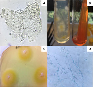 A) Examen directo de las escamas obtenidas por raspado de la lesión con KOH al 40% con tinta Parker® azul-negra permanente (400×). B) Aspecto macroscópico de Trichophyton benhamiae. Cultivo primario de escamas de lesión con desarrollo en agar Sabouraud y agar selectivo y diferencial para dermatofitos (DTM). C) Subcultivo en placa de agar Sabouraud, micelio velloso blanco con pigmento amarillo. D. Micromorfología de T. benhamiae en disgregado con azul de lactofenol (400×). Microconidios globosos ovales o claviformes que se originan lateralmente y se disponen formando racimos.