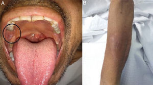 Mucocutaneous lesions. a. Right peri-tonsillar pillar injury (circle). b. Erythematous, indurated plaques on the left forearm.