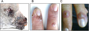 Lesions caused by ORFV infection in an Argentine rural worker. (A) Photograph of a dramatic ORFV infection in a 3-month-old affected lamb. (B) Three erythematous papules are observed on the back of the right hand. (C) Few days later, papules evolved into inflammatory nodules measuring 2cm in diameter.