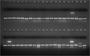 Productos de amplificación en gel de agarosa de aislamientos de E.coli intestinal (líneas 1 a 16) y cepas control (líneas 17 a 20). Arriba, PCR1. línea 6: gen stp, líneas 1 a 5 y 7 a 16: sin factores de virulencia, línea 17: gen eae (E.coli 2348/69), línea 18: genes lt y stp (E.coli KNH-172), línea 19: gen sth (E.coli O126-53), línea 20: gen 16S (E.coli ATCC25922, control de amplificación). Abajo, PCR2. Línea 2: gen ipaH; líneas 13 y 15: gen aggR; líneas 1, 3 a 12, 14 y 16: sin factores de virulencia; línea 17: gen ipaH (E.coli C-481); línea 18: gen aggR (E.coli 17-2); línea 19: genes stx1 y stx2 (E.coli EDL933); línea 20: gen 16S (E.coli ATCC 25922, control de amplificación).