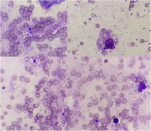 Cytology of the ulcerated lesions in the cat. Phagocytosis of yeast cells by macrophages is observed.