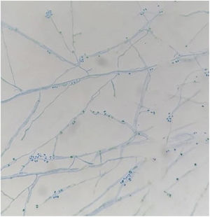 The microscopic morphology observed in the culture at 25°C showed septate hyphae and hyaline or slightly pigmented conidia that grouped into rosettes at the tips of the conidiophores (400×).