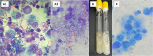 (A) Structures with internal septa that form small endospores arranged in a morula-like pattern. (A1) Cytology of a submandibular lymph node sample stained with methanol-Giemsa. Optical microscope, 1000×. (A2) May Grünwald-Giemsa staining of submandibular lymph node sample. 1000×. (B) Macromorphology after three days of incubation in Sabouraud-glucose at 28°C. (C) Microscopic morphology observed in the culture at 28°C with lactophenol blue; spherules (sporangia) of different sizes are observed, 400×.
