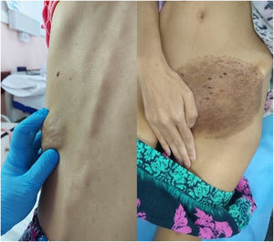 Tumoral lesion on the back (right); desquamative inguinal plaque (left).