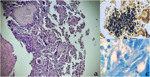Back lesion histopathology: chronic granulomatous inflammation with grain-like structures composed by septate hyphae (a), PAS and Grocott stain positive (b), as well as acid-fast bacilli positive stain (c).