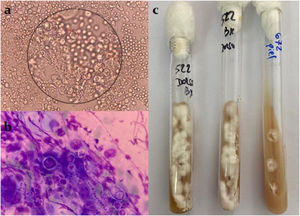 Septate hyaline hyphae on direct examination (a) and Giemsa stain (b), M. canis colonies on agar Sabouraud culture (c).