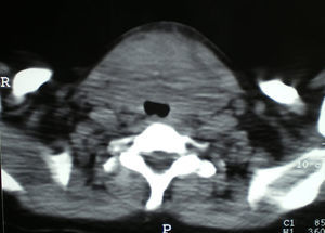 Extensa lesión ocupante tiroidea con infiltración y desplazamiento posterior de la luz traqueal.