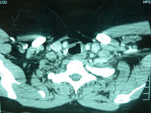 Control tomográfico alejado postraqueoplastia y anastomosis cricotraqueal.