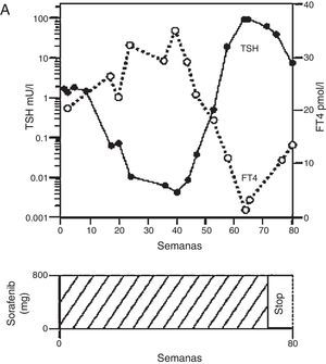Tiroiditis en paciente en tratamiento con sorafenib. Adaptado de van Doorn et al.36.