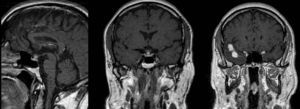 Imagen izquierda y central: tallo engrosado y ausencia de señal hiperintensa en T1 de la neurohipófisis, indicativo de hipofisitis. Imagen derecha: nódulos subcorticales de 10 y 15 mm con edema perilesional.