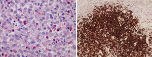 Proliferación de histiocitos de Langerhans en hematoxilina eosina e inmunohistoquímica positiva para CD1a.