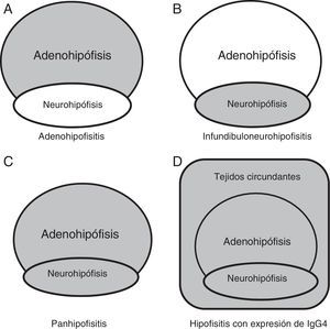 Compromiso anatómico. A) Hipófisis anterior en adenohipofisitis. B) Hipófisis posterior con/sin afectación de tallo hipofisario en infundibuloneurohipofisitis. C) Ambas regiones en panhipofisitis. D) Compromiso selar y paraselar en las hipofisitis linfoplasmocitarias con expresión de IgG4. Adaptado de Shimatsu et al.21.