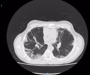 Tomografía de tórax, ventana pulmonar, corte axial. Confirma infiltrados intersticiales.