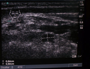 Incidentaloma paratiroideo de 0,64×0,50cm.