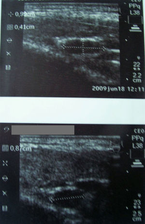 Incidentalomas bilaterales.