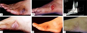 A) Eumycetoma – Madurella mycetomatis. B) After deep surgical debridement. C) 30 days after surgical procedure. D) Six months after surgical procedure. E) Magnetic resonance imaging (MRI) of the tumor. F) Patient after mycological and clinical cure