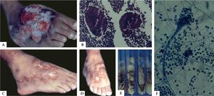 A) Eumycetoma – Scedosporium apiospermum. B)Eumycetoma grain on histopathology (Hematoxylin & eosin, X40). C and D) After clinical and surgical treatment. E) Cultures in specific media. F) Strands of hyphae and conidia - Synnema (Lactophenol cotton blue X20)