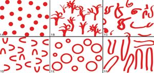 A: Punctate blood vessels. B: Dendritic blood vessels. C: Polymorphic blood vessels. D: Curved blood vessels. E: Annular blood vessels. F: Hairpin-like blood vessels