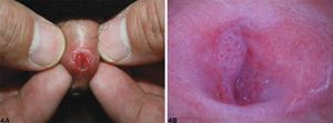 A. Skin lesions on urethral orifice under visual observation. B. Flat warts and punctate blood vessels under dermoscopy