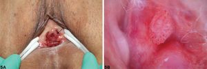 A. Skin lesions on urethral orifice under visual observation. B. Papillary warts, punctate blood vessels and polymorphic blood vessels under dermoscopy