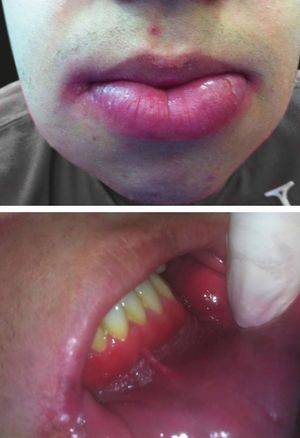 Patient 1 at his first consultation. A - Evident symmetrical lower lip swelling and angular cheilitis. B - “Full-width” gengivitis