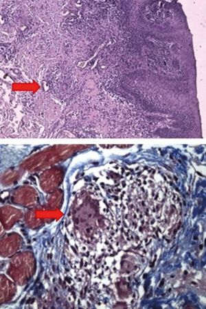 Patient 1. Histopathology of lip mucosa. A - Hematoxylin & eosin stain with inflammatory infiltrate, non-caseating granulomas and giant multinucleate cells (arrow) (X4). B - Masson stain showing noncaseating granuloma and giant multinucleate cells (arrow), adjacent to muscle fibers (X40)