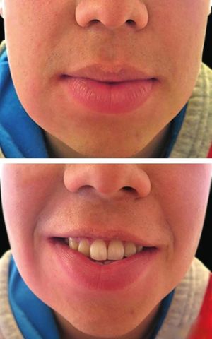 Patient 1 at 18-month follow-up. A: Asymmetrical lower lip swelling, with soft tissue enlargement of right cheek. B: Slight asymmetrical smile