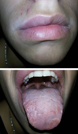 Patient 2 at his first consultation. A: Right upper lip swelling, with mild lower lip edema. B: Fissured and geographic tongue